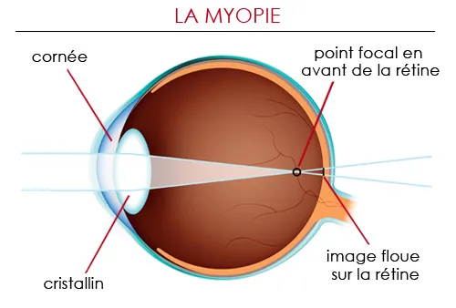 La myopie